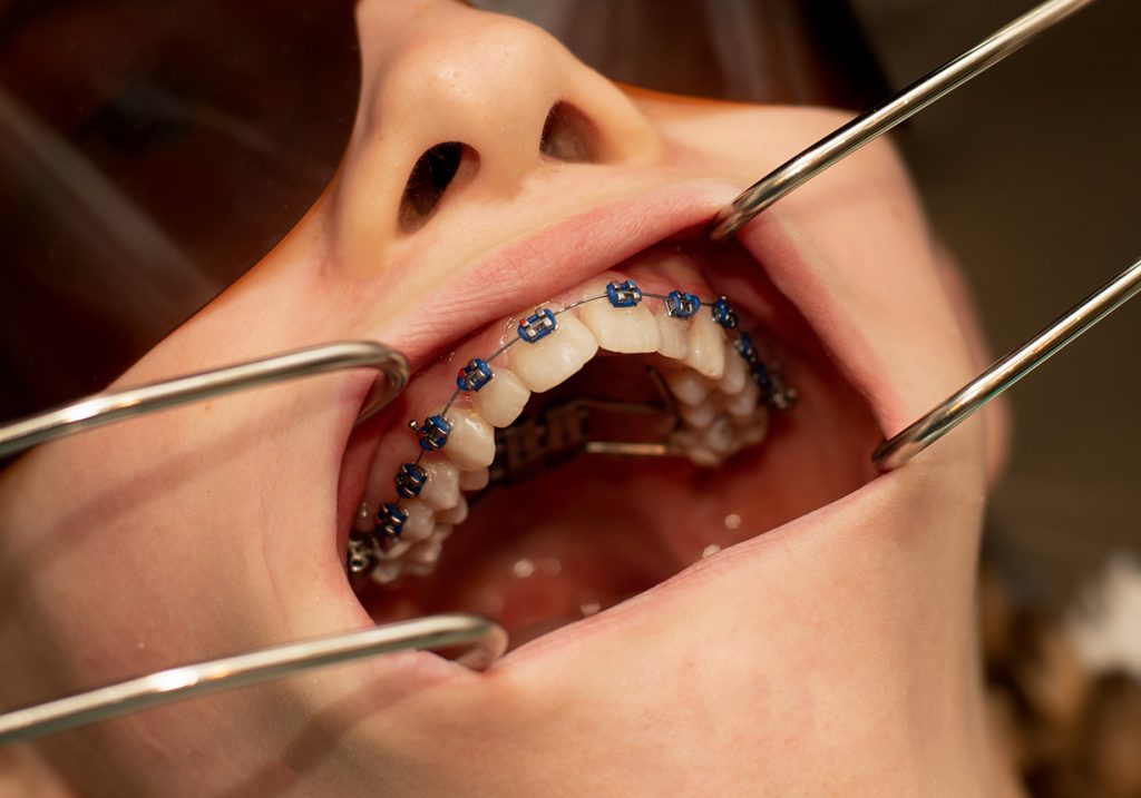 Glossary of Orthodontic Terms Smile Life